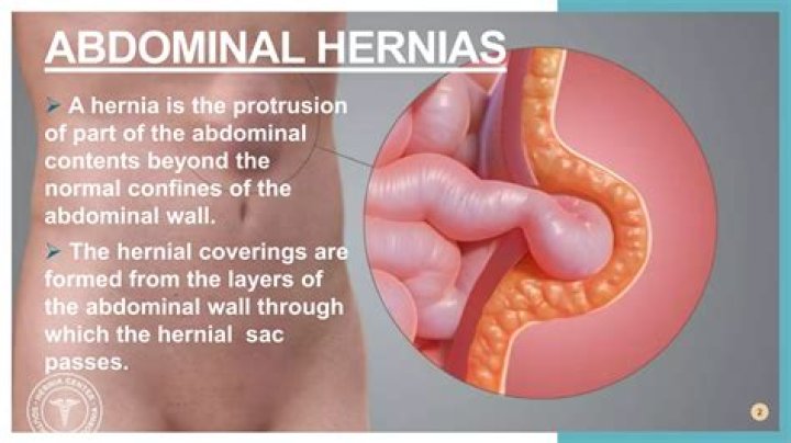Are hernias always painful?