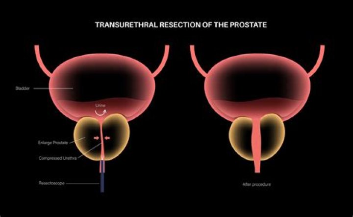 Are you impotent after prostate surgery?