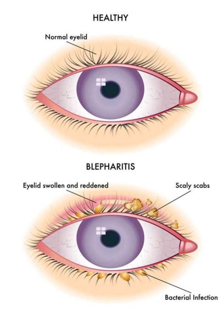Can blepharitis be caused by stress?
