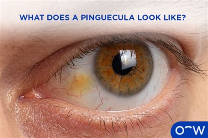 Can blue light cause pinguecula?
