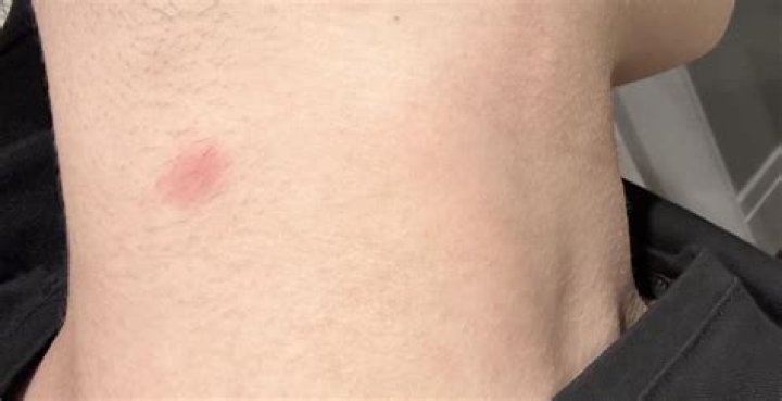 Can bug bites scar?