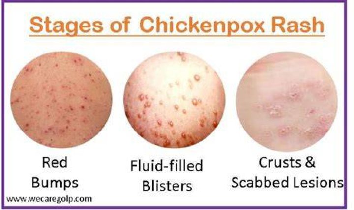 Can chickenpox not be itchy?