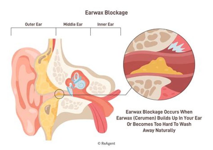 Can impacted ear wax cause vertigo?