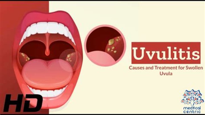 Can you have two uvulas?
