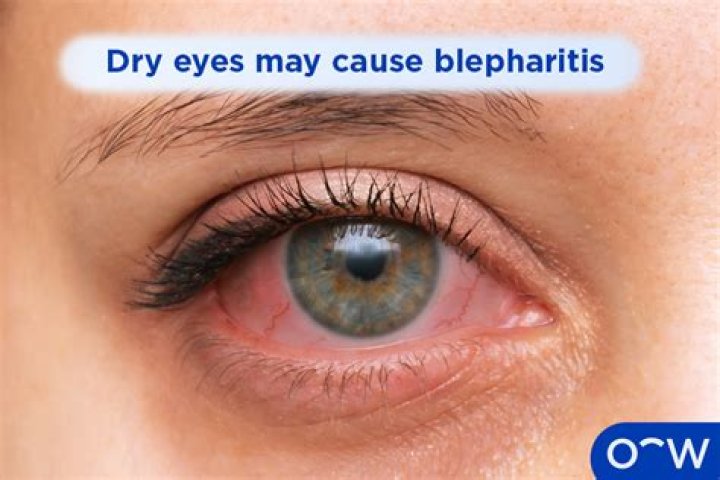 Do allergies cause blepharitis?