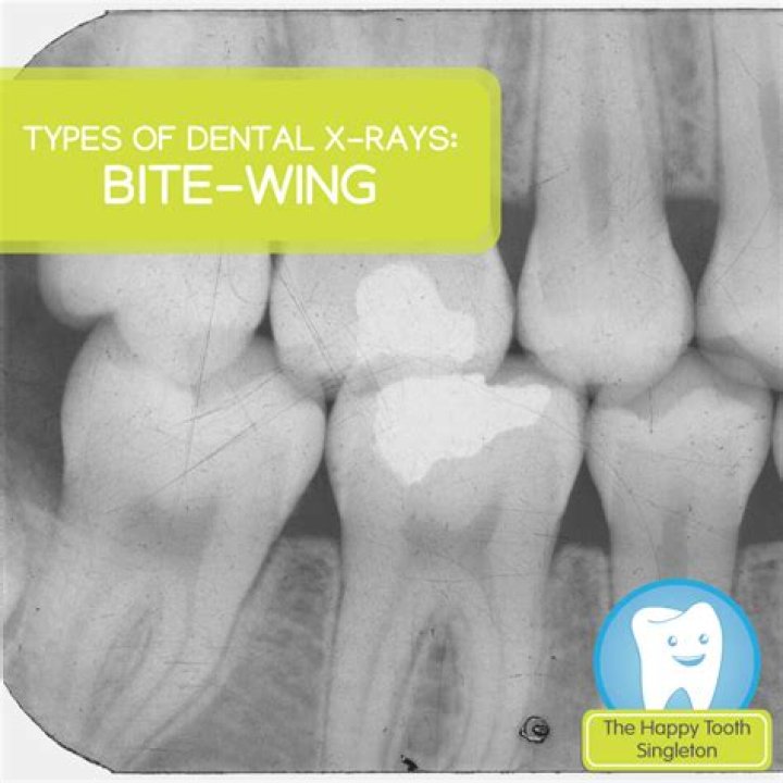 Do bitewings show front teeth?