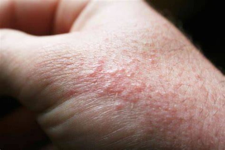 Do heat rashes spread?