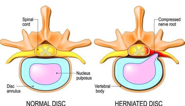 Do intervertebral discs regenerate?