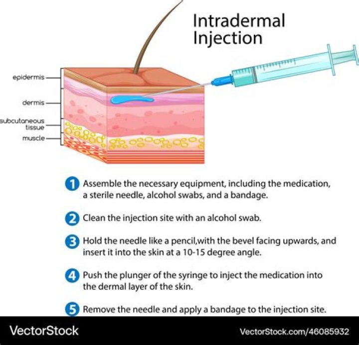 Do intradermal injections hurt?
