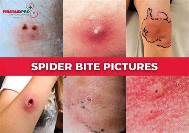 Do spiders sting when they bite?