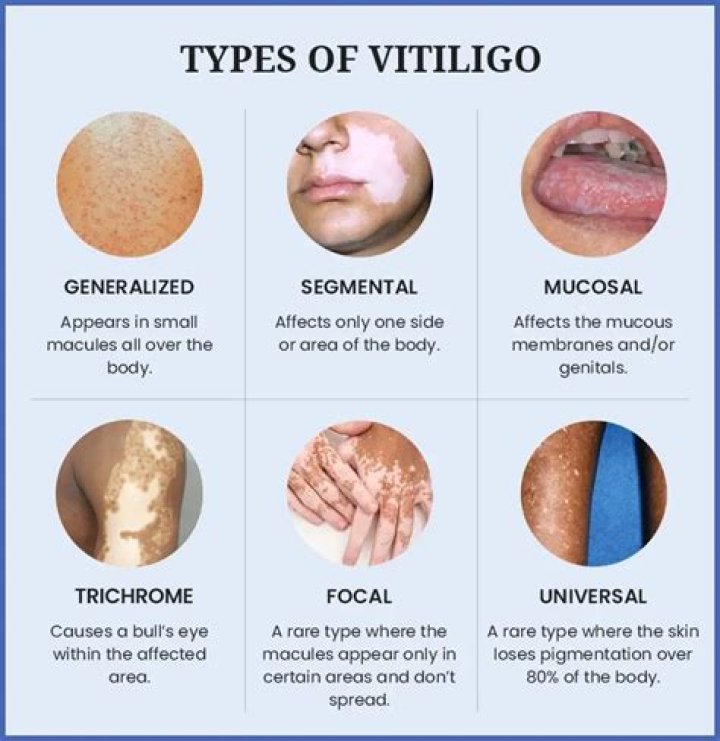 Do vitiligo patches go away?