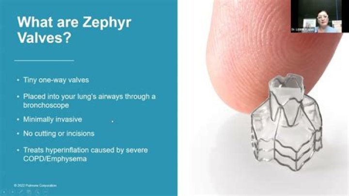 Do zephyr valves work?