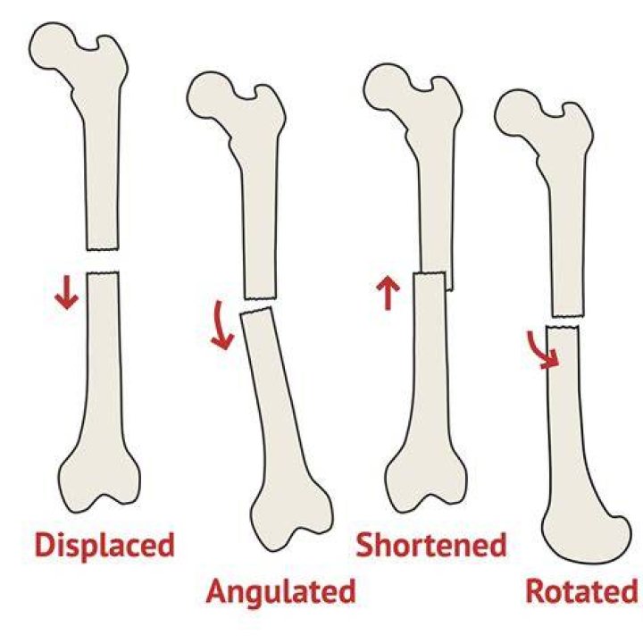 Does angulated mean displaced?