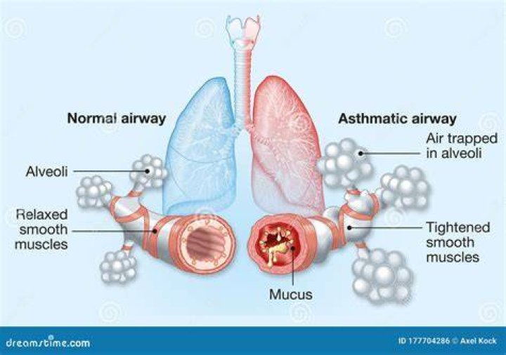 Does asthma affect alveoli?