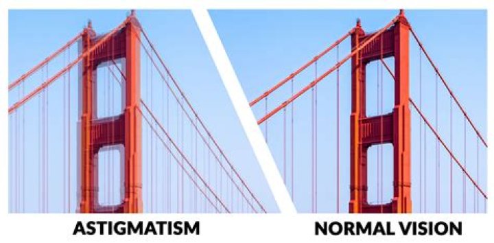 Does astigmatism cause double vision?