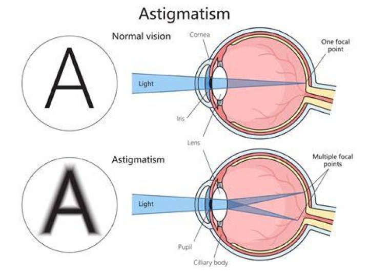 Does astigmatism get worse?