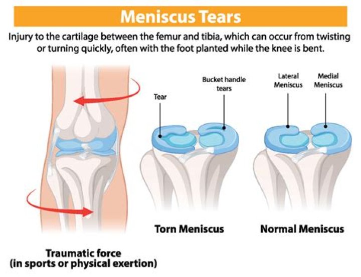 Does every synovial joint have a meniscus?