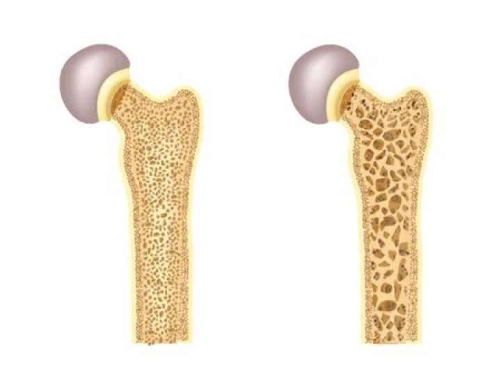 Does fosamax build bone?
