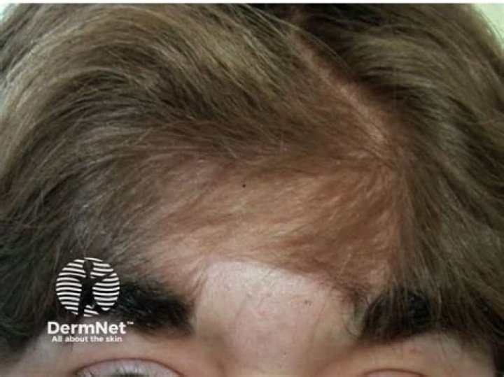 Does hypertrichosis go away?
