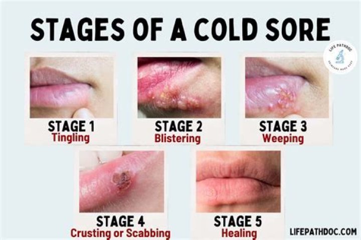 Does ice work on cold sores?