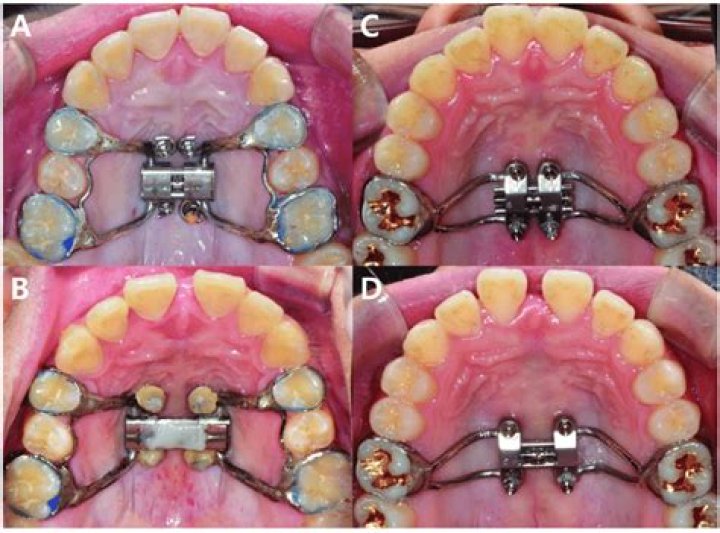 Does orthodontia include implants?