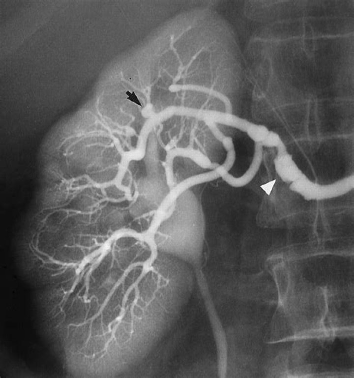 Does polyarteritis nodosa come and go?