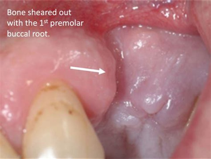 Does removing premolars hurt?
