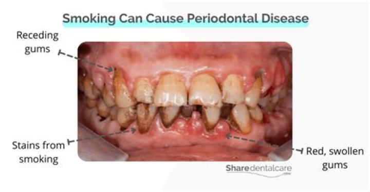 Does smoking cause periodontitis?