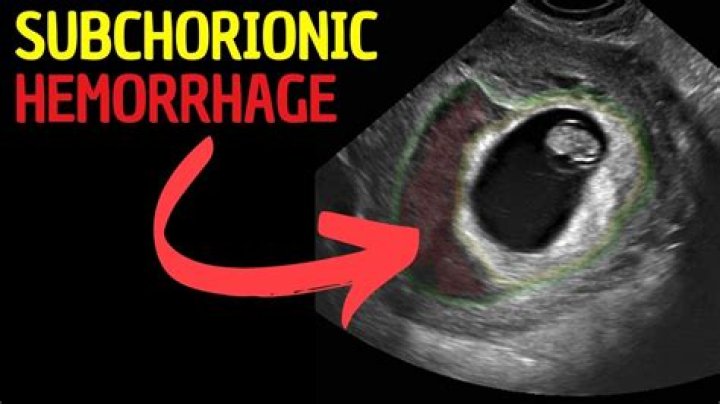 Does subchorionic hemorrhage go away?