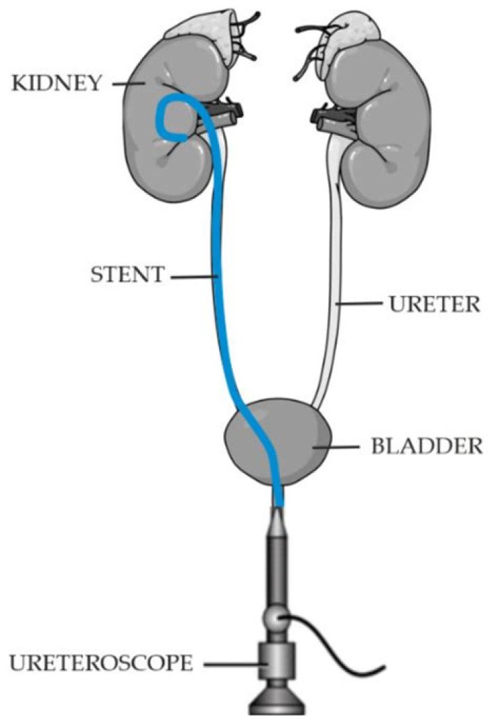 Does ureteroscopy require stent?