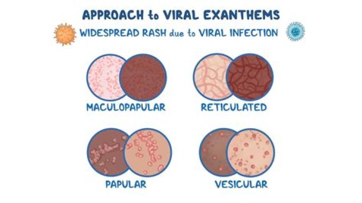 Does viral exanthem itch?