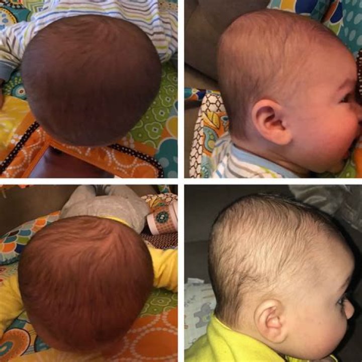 Has my baby got flat head?