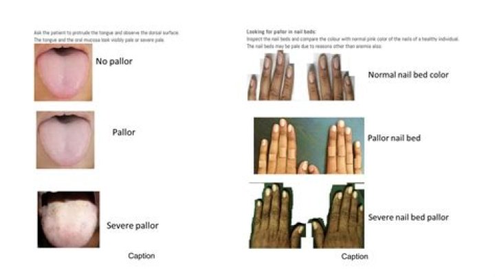 How is pallor defined?