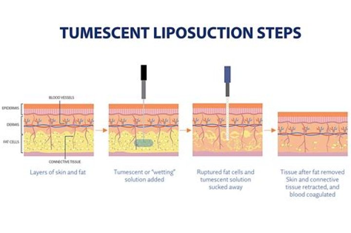 How much is tumescent liposuction?