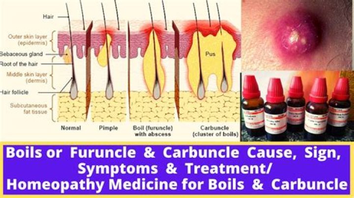 How to cure furunculosis?