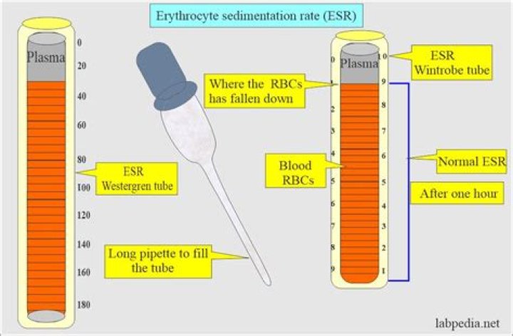 How to lower sedimentation rate?