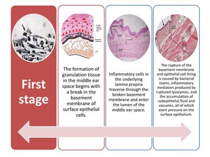 In ear granulation tissue?