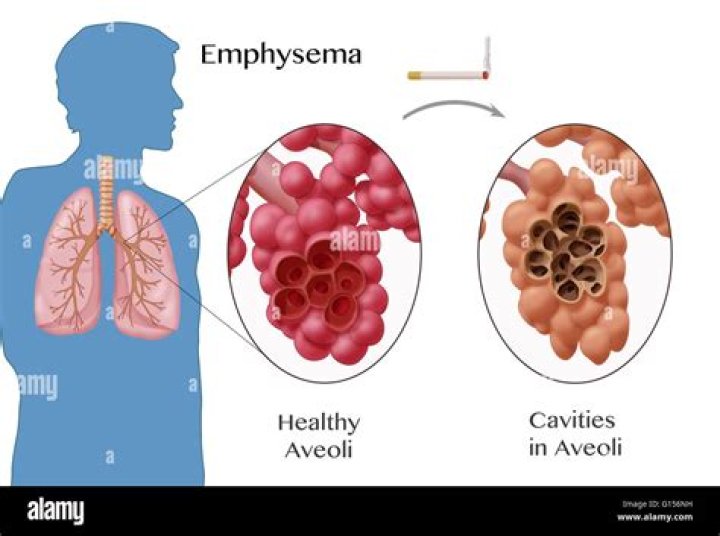 In emphysema the alveoli?
