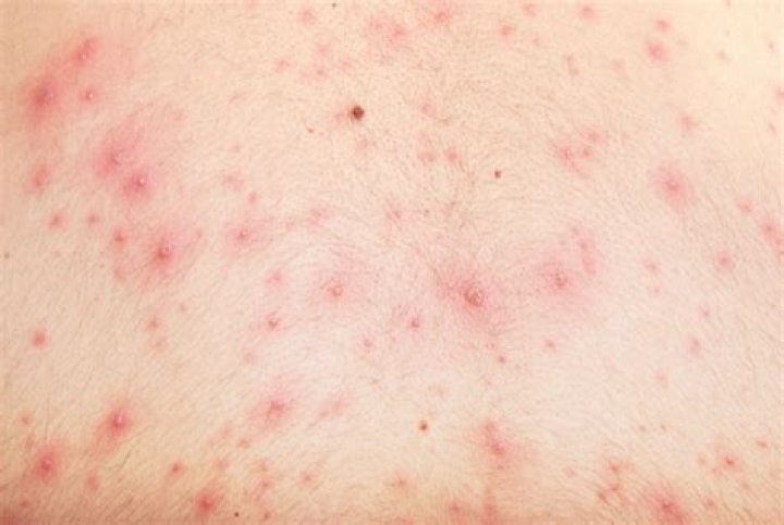 Is chickenpox still around?