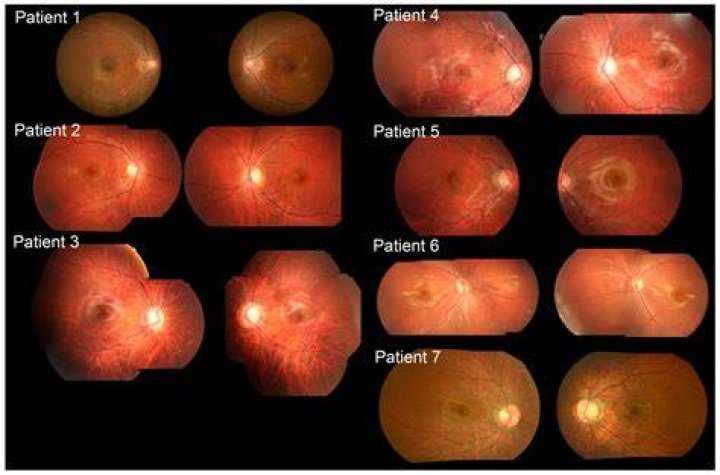 Is night blindness genetic?