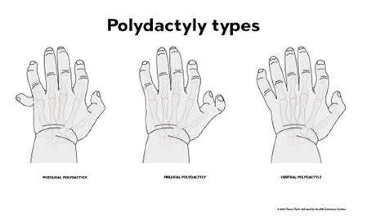 Is polydactyly a word?