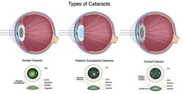Is subcapsular one word?
