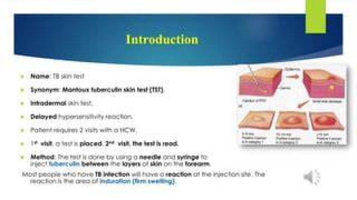 Is tb test intradermal?