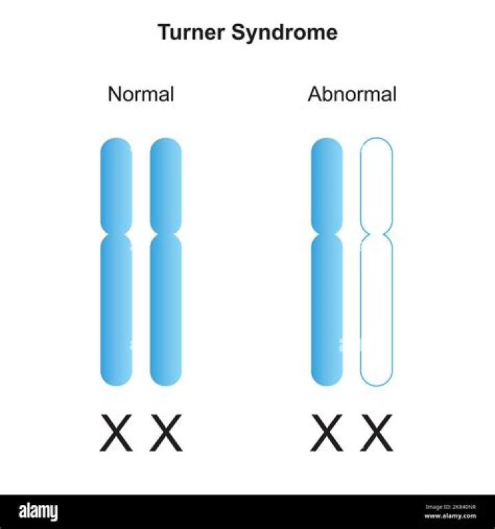 Is turner syndrome monosomy?