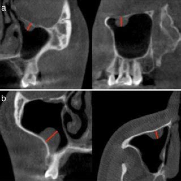 Should a mucous retention cyst be removed?