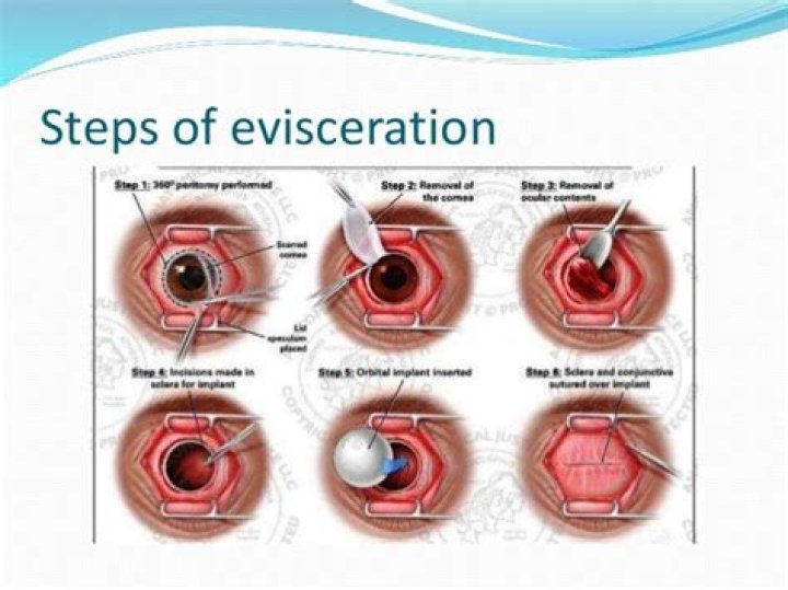 What does evisceration mean?