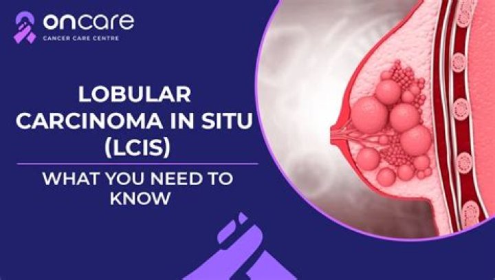 What is lobular cancer?