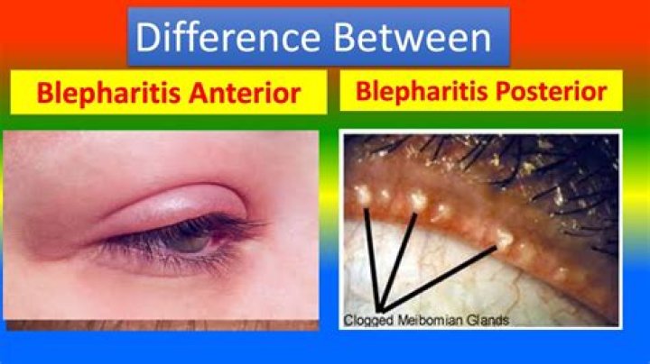 What is posterior blepharitis?