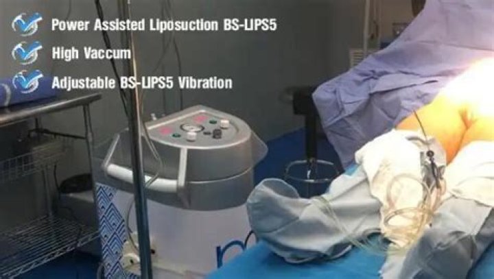What is suction assisted lipectomy?
