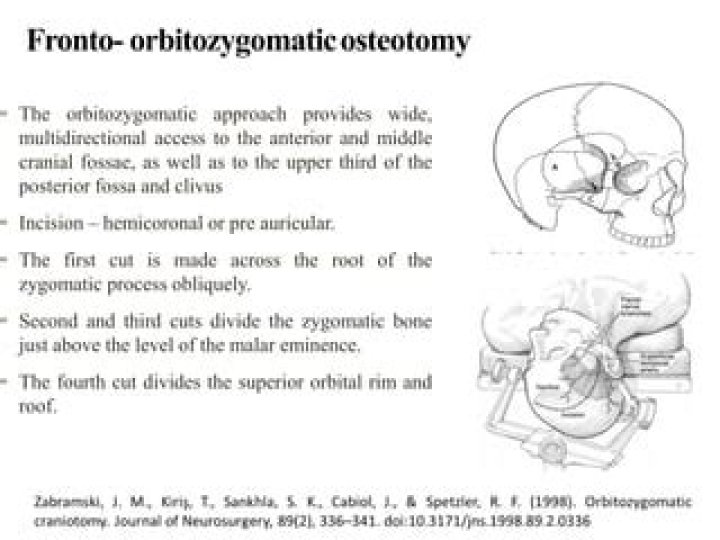 What is the orbitozygomatic approach?